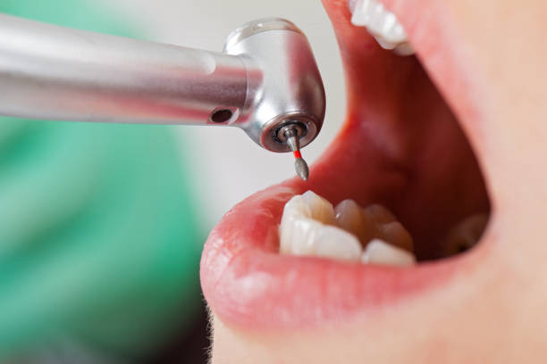 Best Emergency Wisdom Teeth Removal in Naples, UT